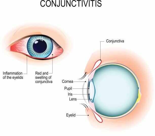 Eyes flu या Conjunctivitis क्या है इसके प्रकार,लक्षण एवम उपचार।